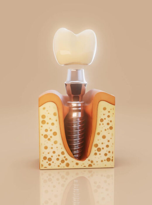 Regeneracja kości pod implant