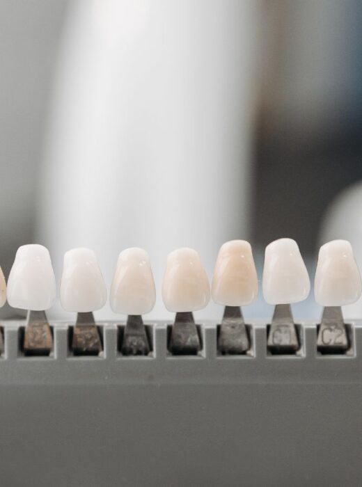 Czy można zakładać licówki na krzywe zęby?