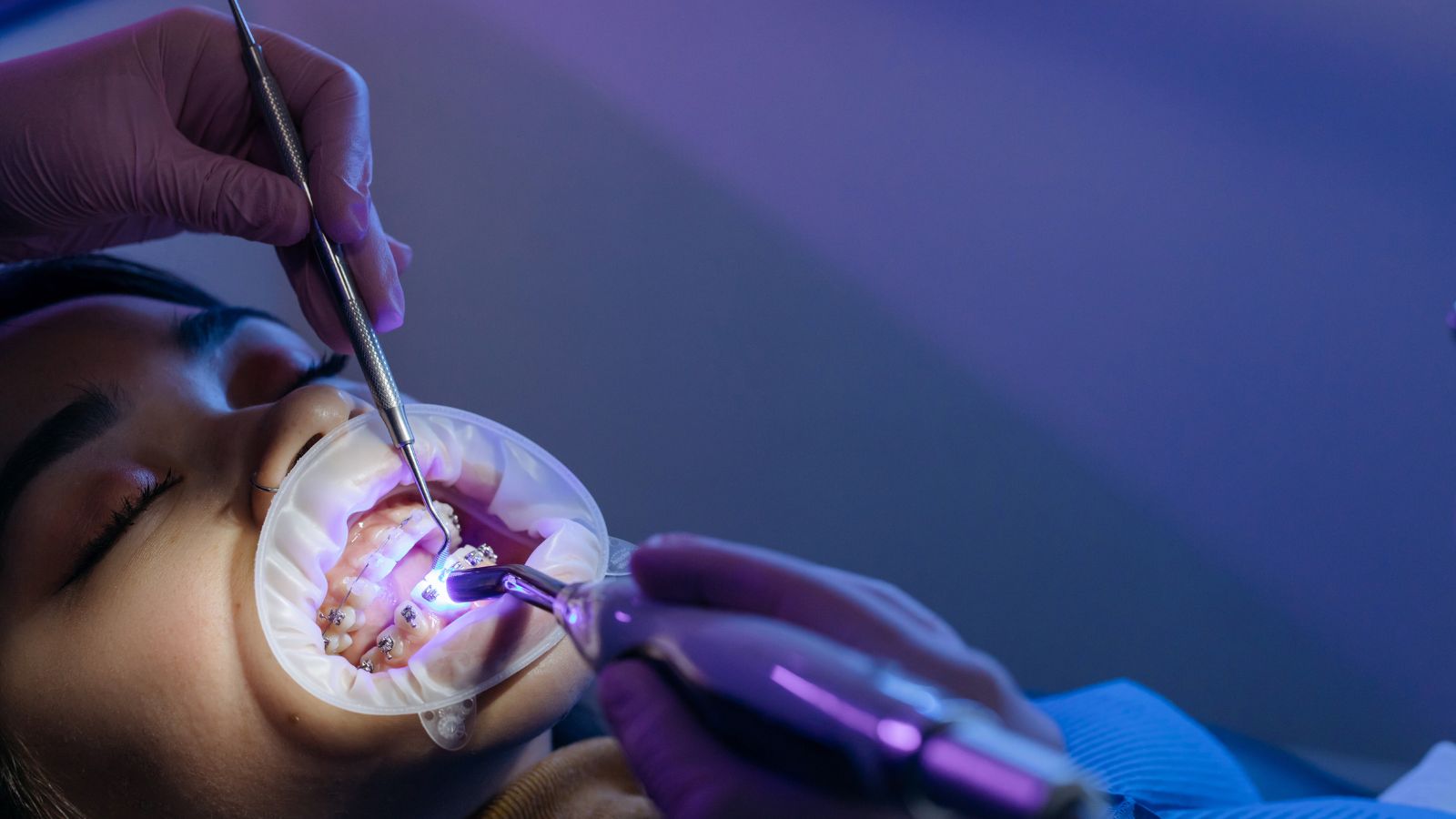 Czy warto zakładać aparat retencyjny po leczeniu ortodontycznym?