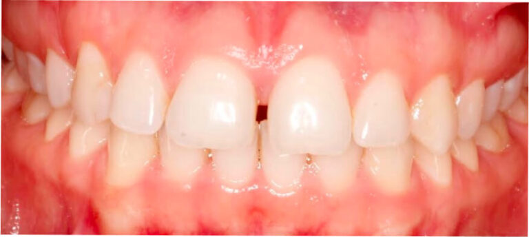 Leczenie kompleksowe, ortodoncja, bonding - przed