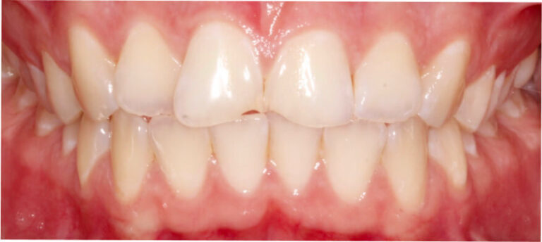 Leczenie kompleksowe, ortodoncja, bonding - przed