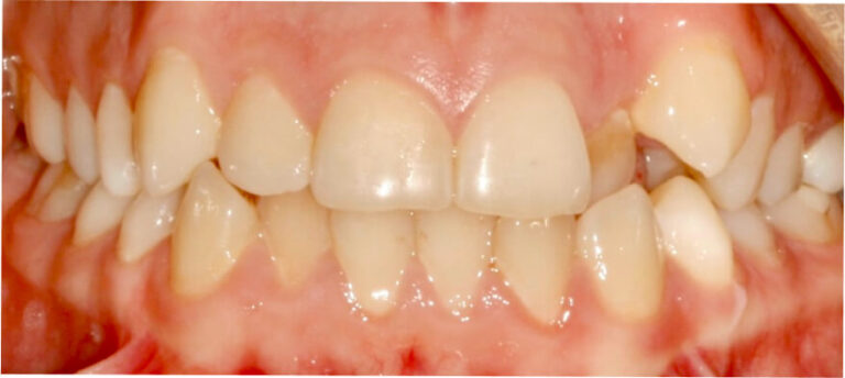 Leczenie kompleksowe, ortodoncja, bonding - przed