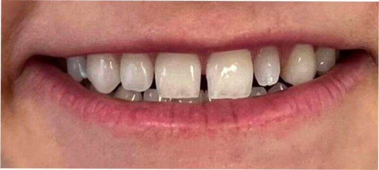 Bonding – licówki kompozytowe - przed