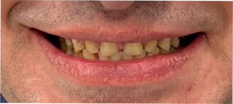 Bonding – licówki kompozytowe 2 - przed