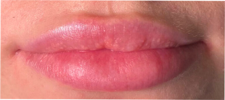 Rozpuszczanie usta hialuronidazą - przed