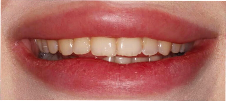 Bonding – licówki kompozytowe - przed