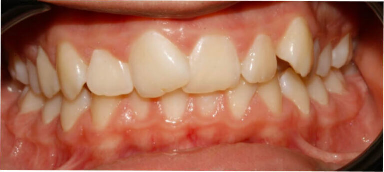 Leczenie kompleksowe, ortodoncja, bonding - przed