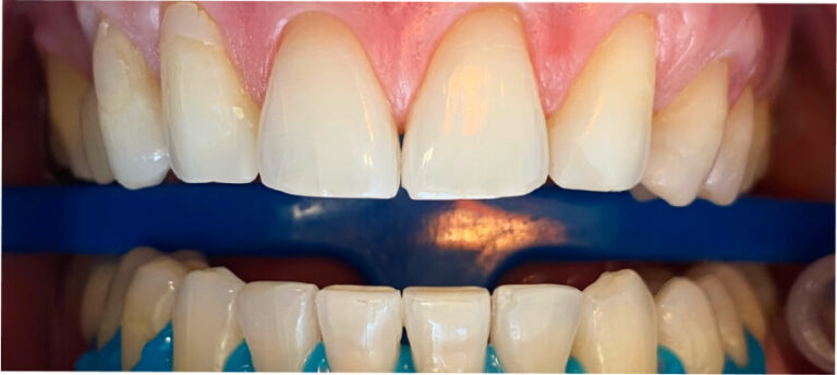 Wybielanie 2 - przed