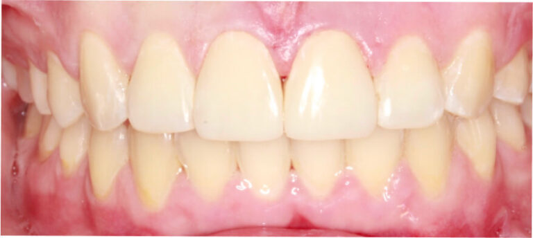 Leczenie kompleksowe, ortodoncja, bonding - po