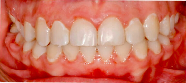 Leczenie kompleksowe, ortodoncja, bonding - po