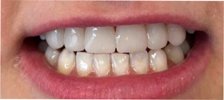 Bonding – licówki kompozytowe - po