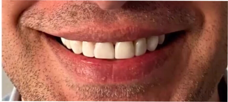 Bonding – licówki kompozytowe 2 - po