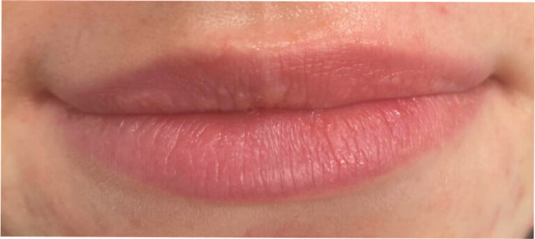 Rozpuszczanie usta hialuronidazą - po