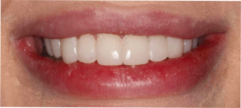 Bonding – licówki kompozytowe - po