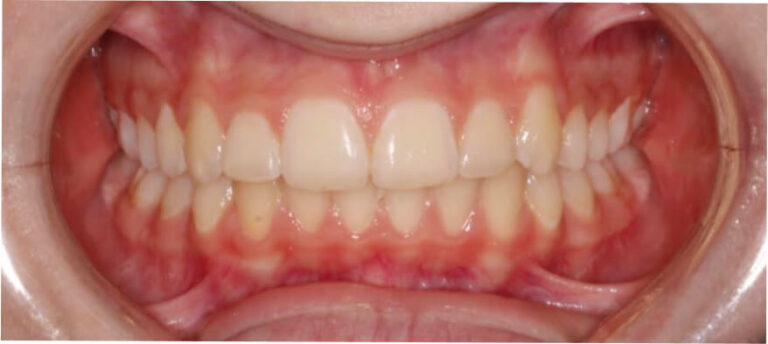 Leczenie kompleksowe, ortodoncja, bonding - po