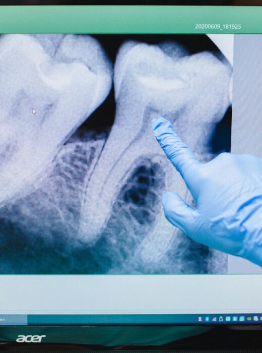 Ekstrakcja zęba zatrzymanego
