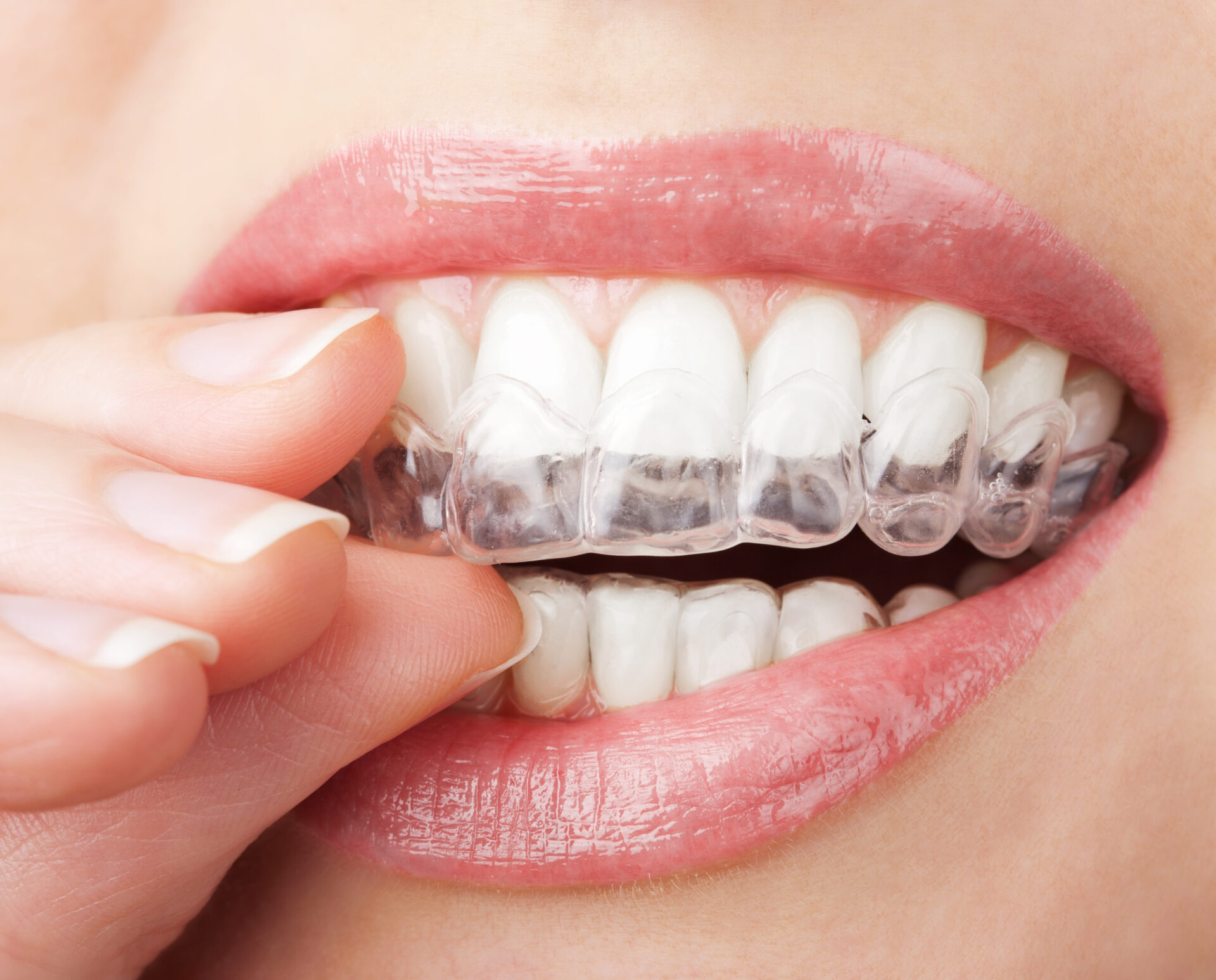Invisalign Warszawa