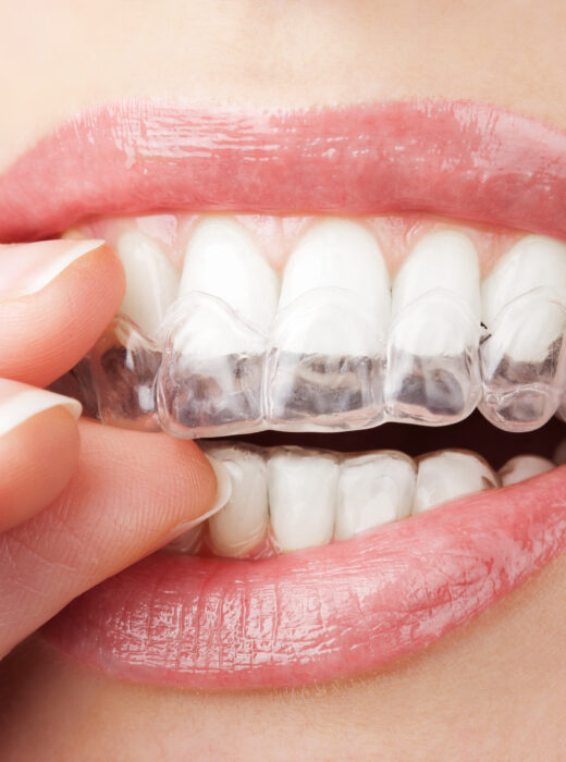 Invisalign Warszawa