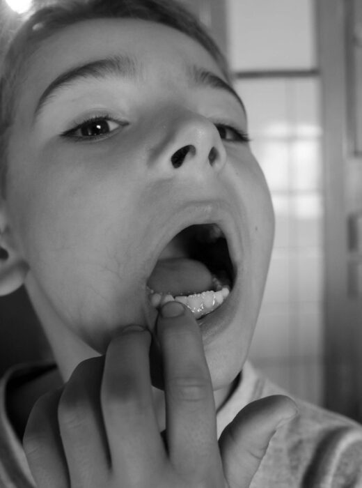 Kserostomia (suchość w ustach) – przyczyny, skutki dla zębów i jak to leczyć