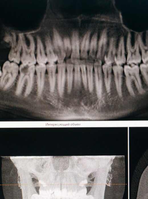 Problemy stawu skroniowo-żuchwowego – trzaski, przeskakiwanie, ból przy żuciu