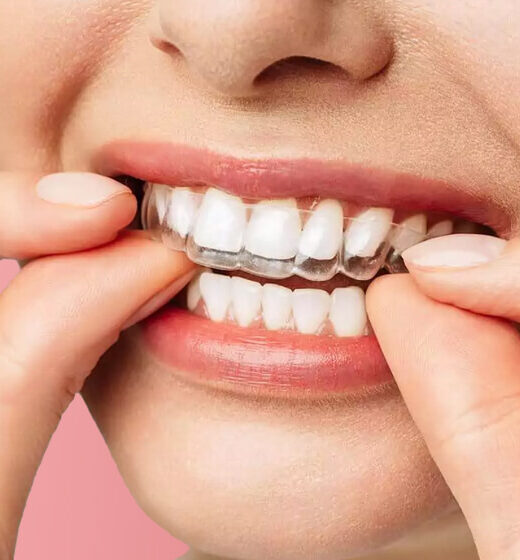 Clear Aligner Warszawa