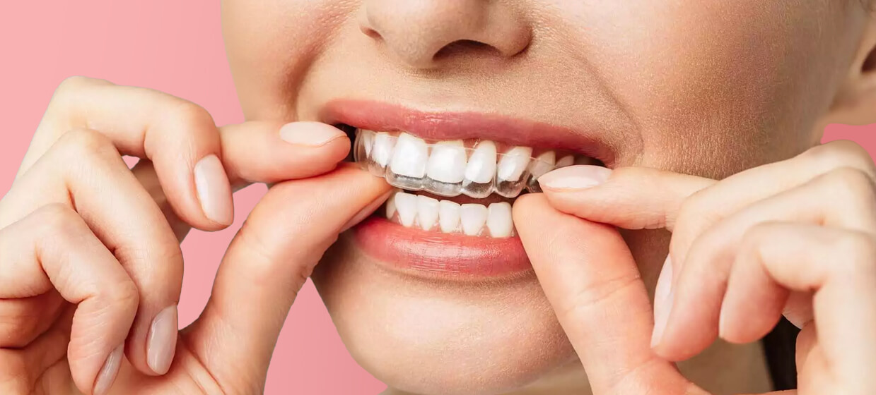 Clear Aligner Warszawa