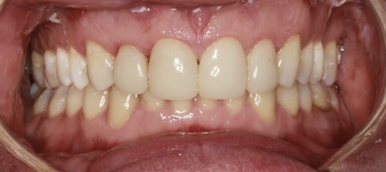 Ortodoncja plus bonding - po