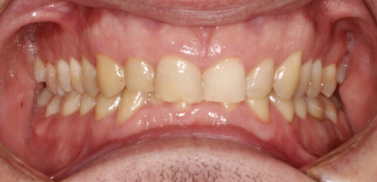 Ortodoncja plus bonding - przed