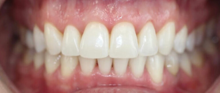 Ortodoncja plus wybielanie - po