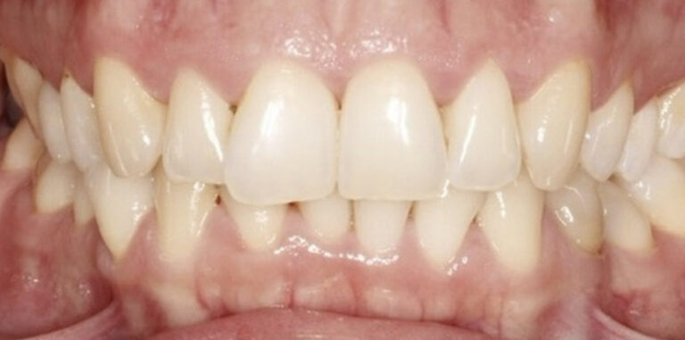 Ortodoncja plus wybielanie - przed