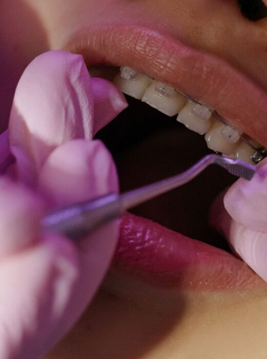 proces zdejmowania aparatu ortodontycznego