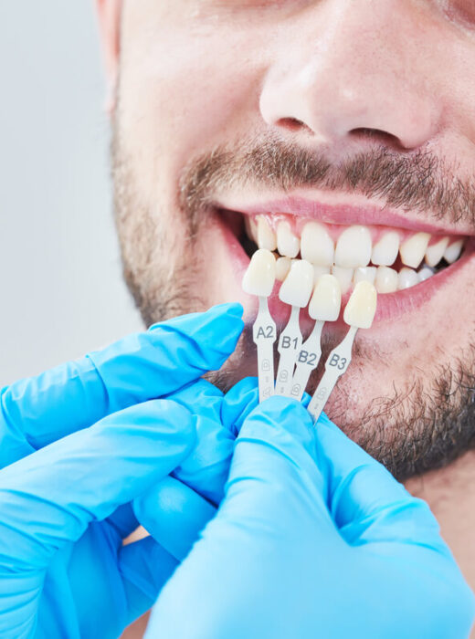 Wybielanie nakładkowe warszawa