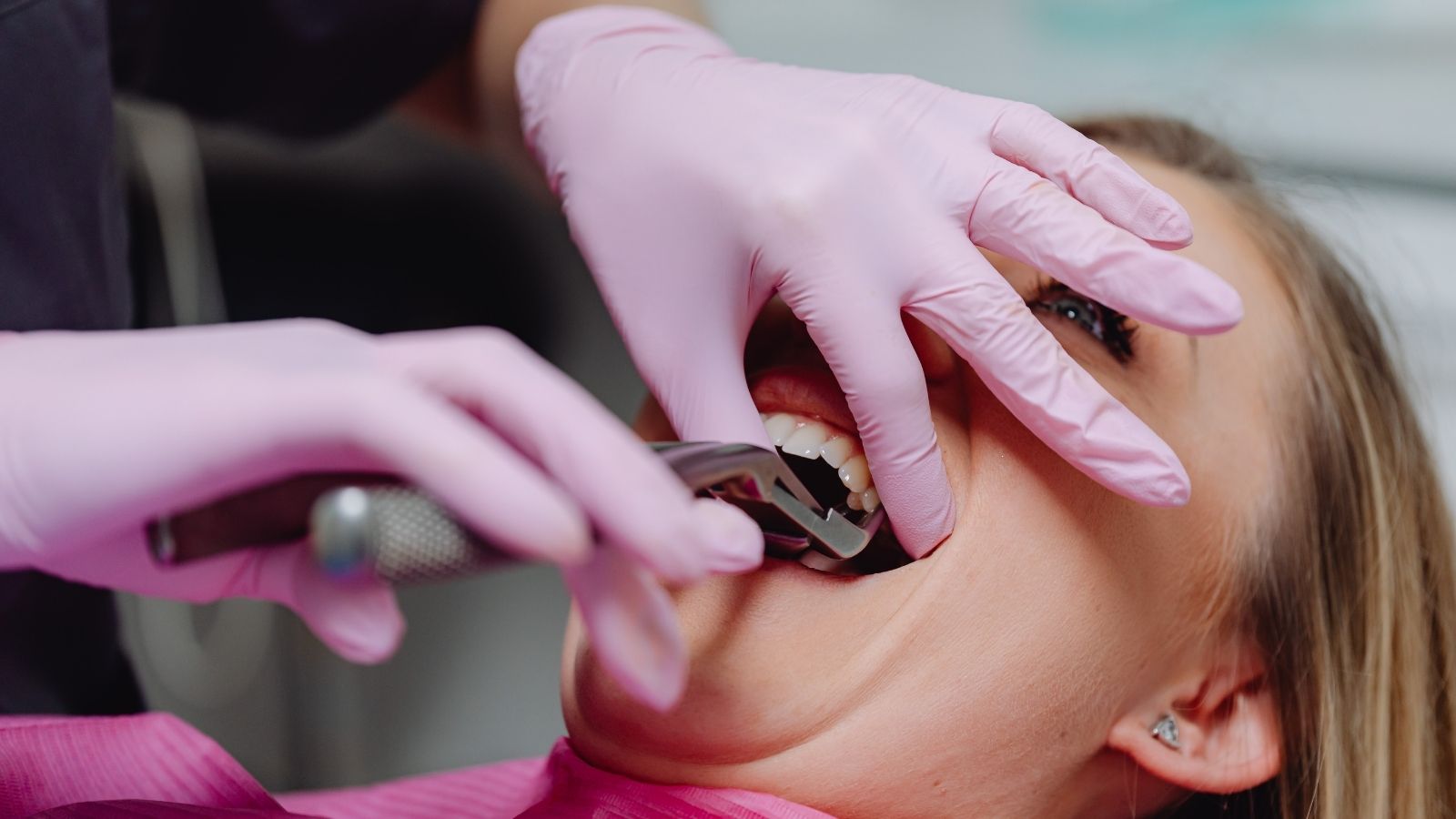 usuwanie zębów stałych warszawa